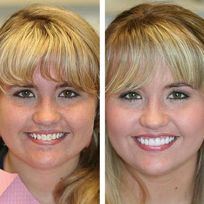 before and after of smile transformation