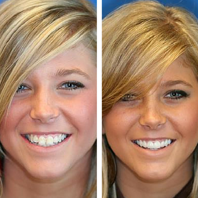 before and after of smile transformation