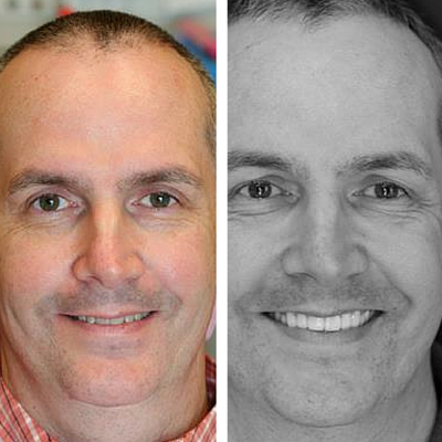 before and after of smile transformation