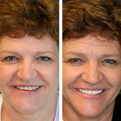 before and after of smile transformation