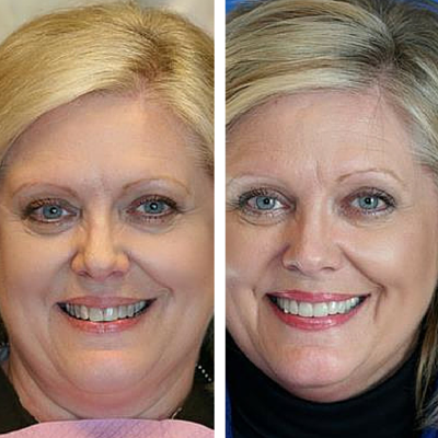 before and after of smile transformation