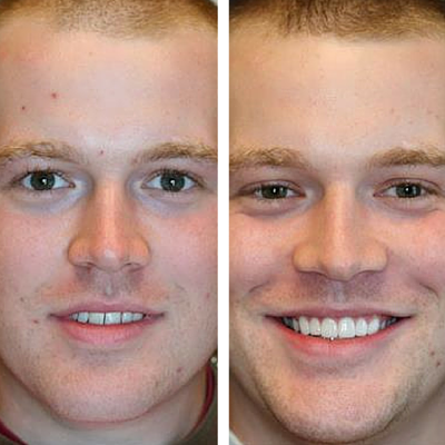 before and after of smile transformation