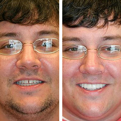 before and after of smile transformation