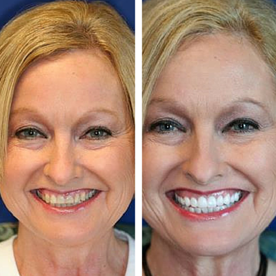 before and after of smile transformation