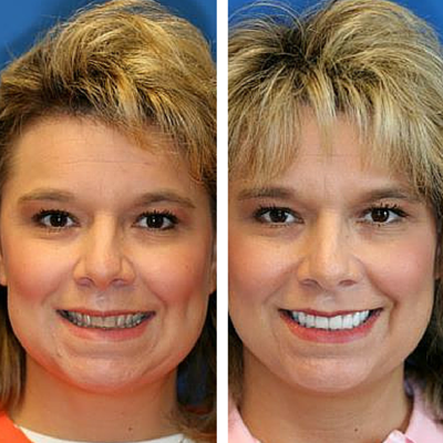 before and after of smile transformation