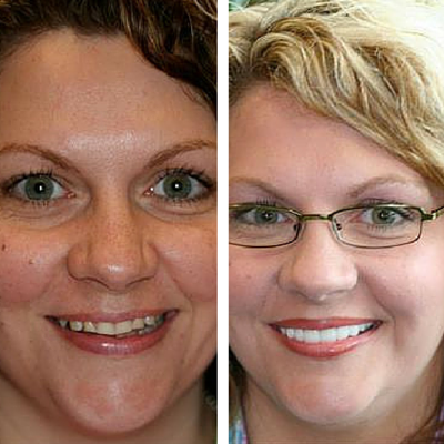 before and after of smile transformation