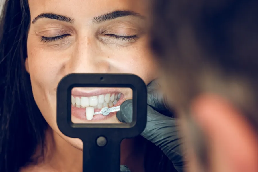 davis dental minimal prep veneers