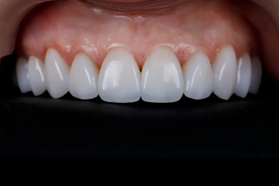 davis dental porcelain veneers