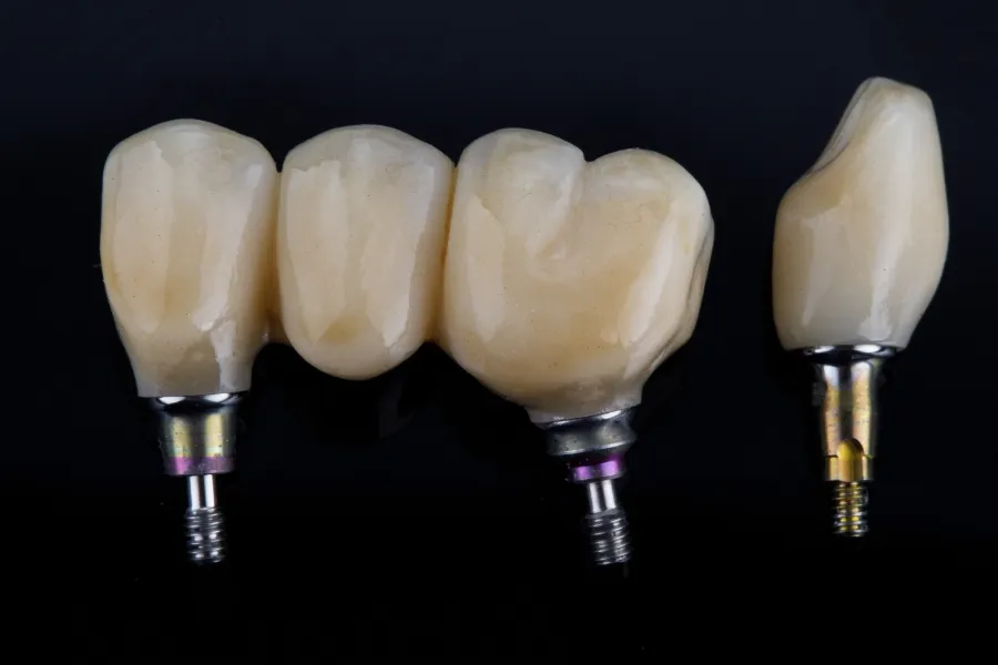 dental crowns bridges