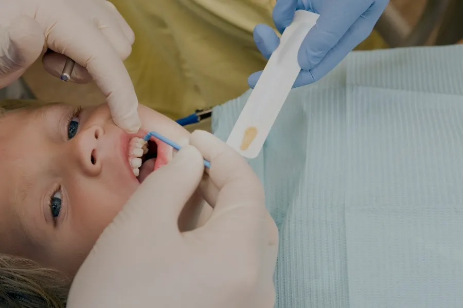 fluoride treatments