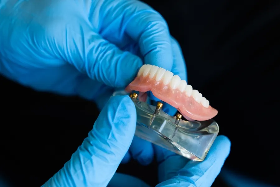 implant retained dentures