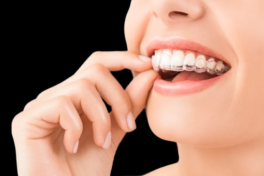 invisalign