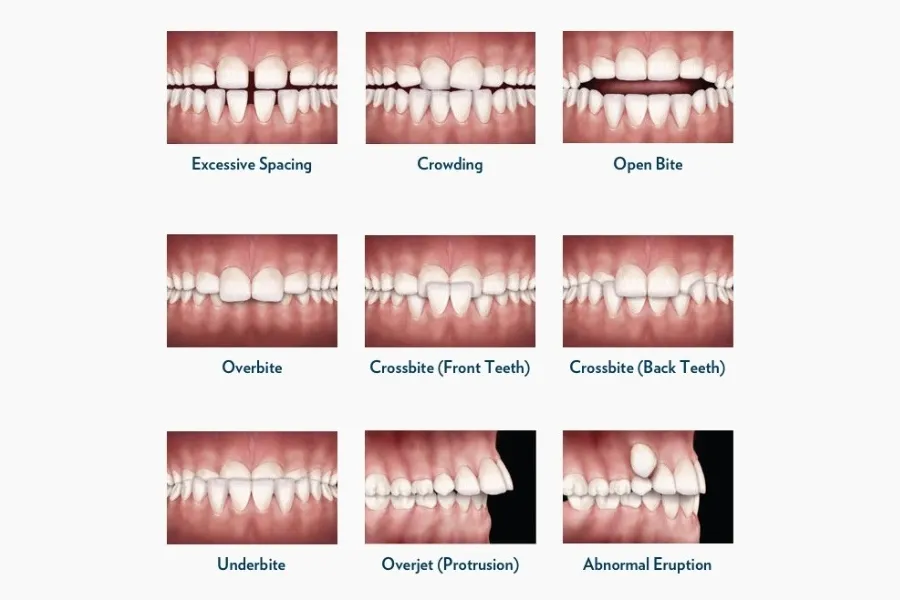 orthodontic problems