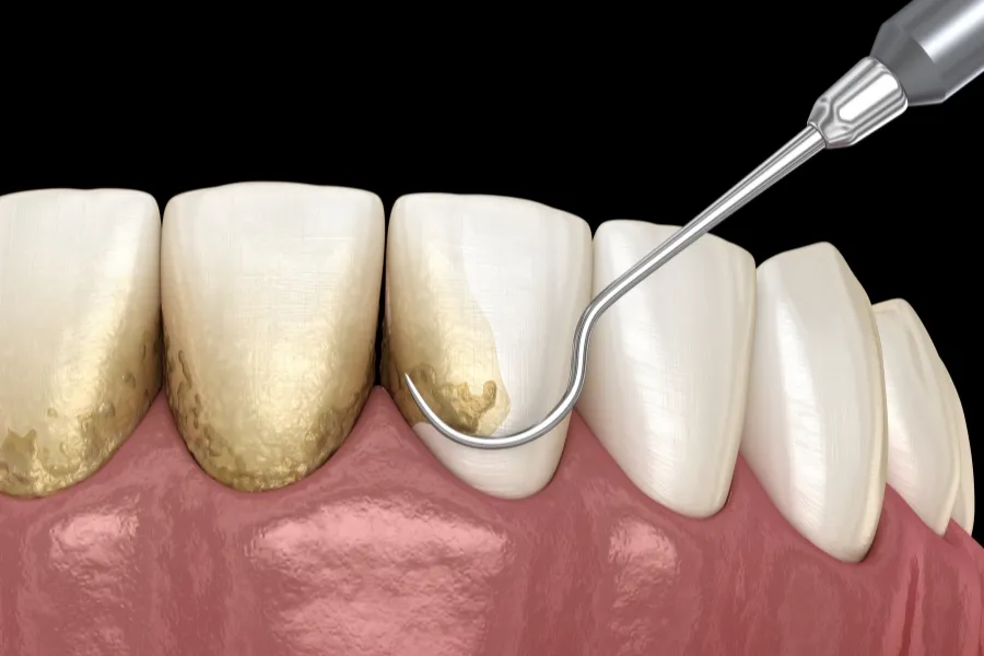 periodontal therapy