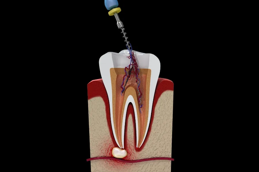 root canal treatment