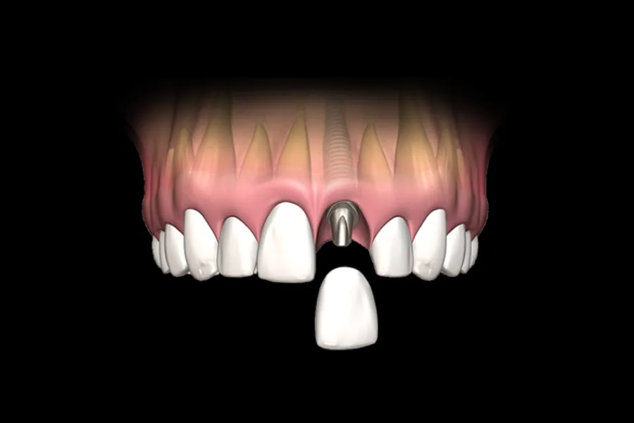 single tooth replacement