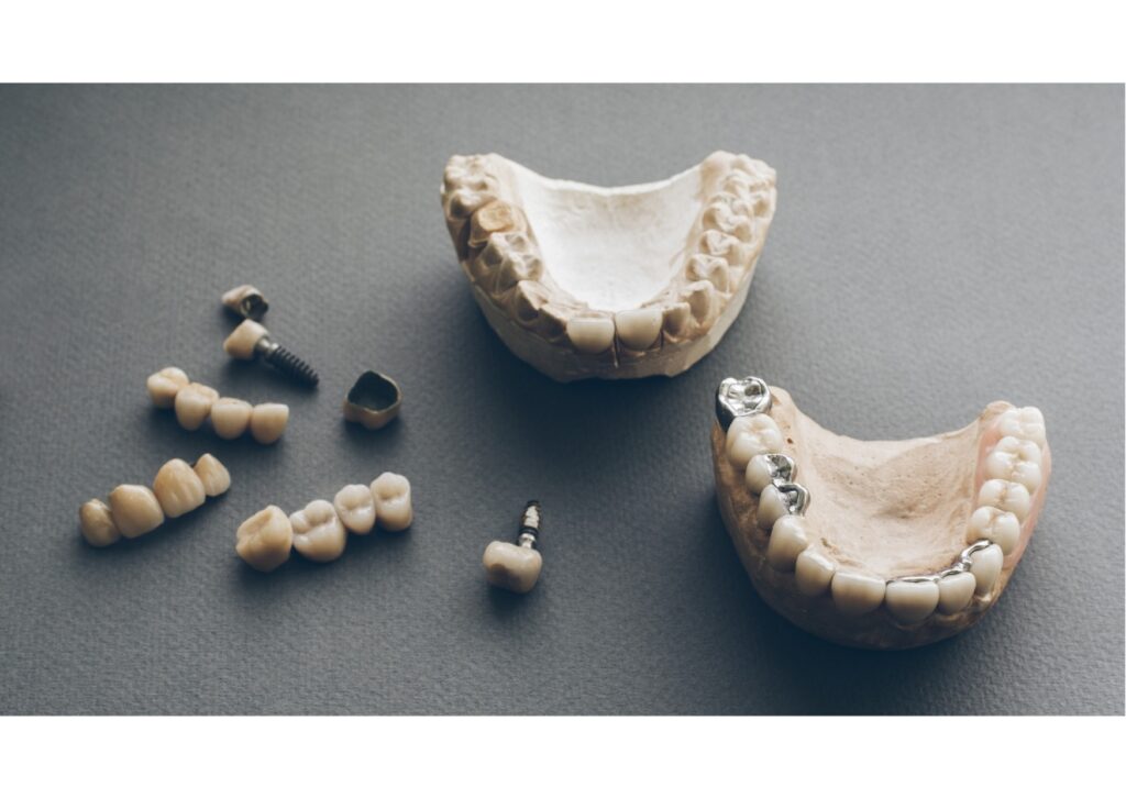 Dental implant models and replacement teeth used to explain dental implant costs and treatment options