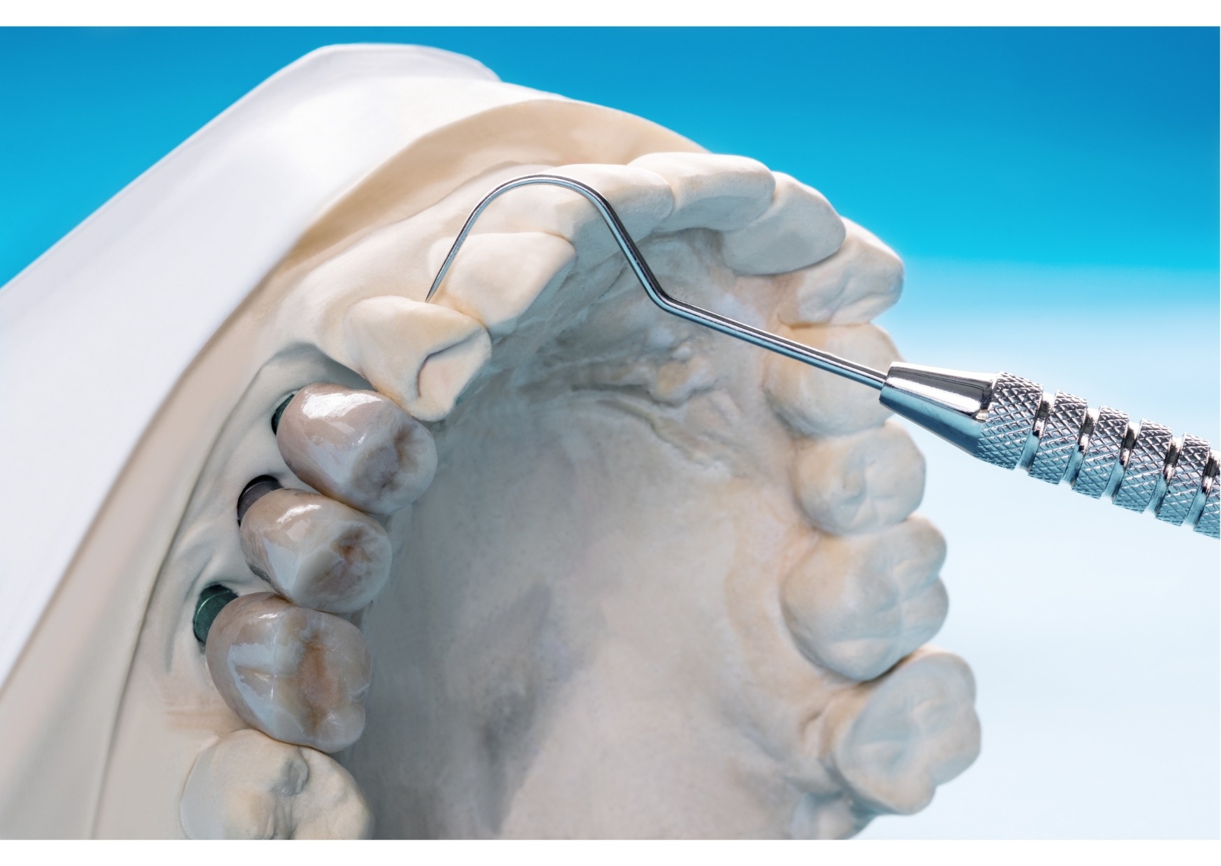 Dental implant model showing replacement teeth and implant posts used to explain dental implant pros and cons