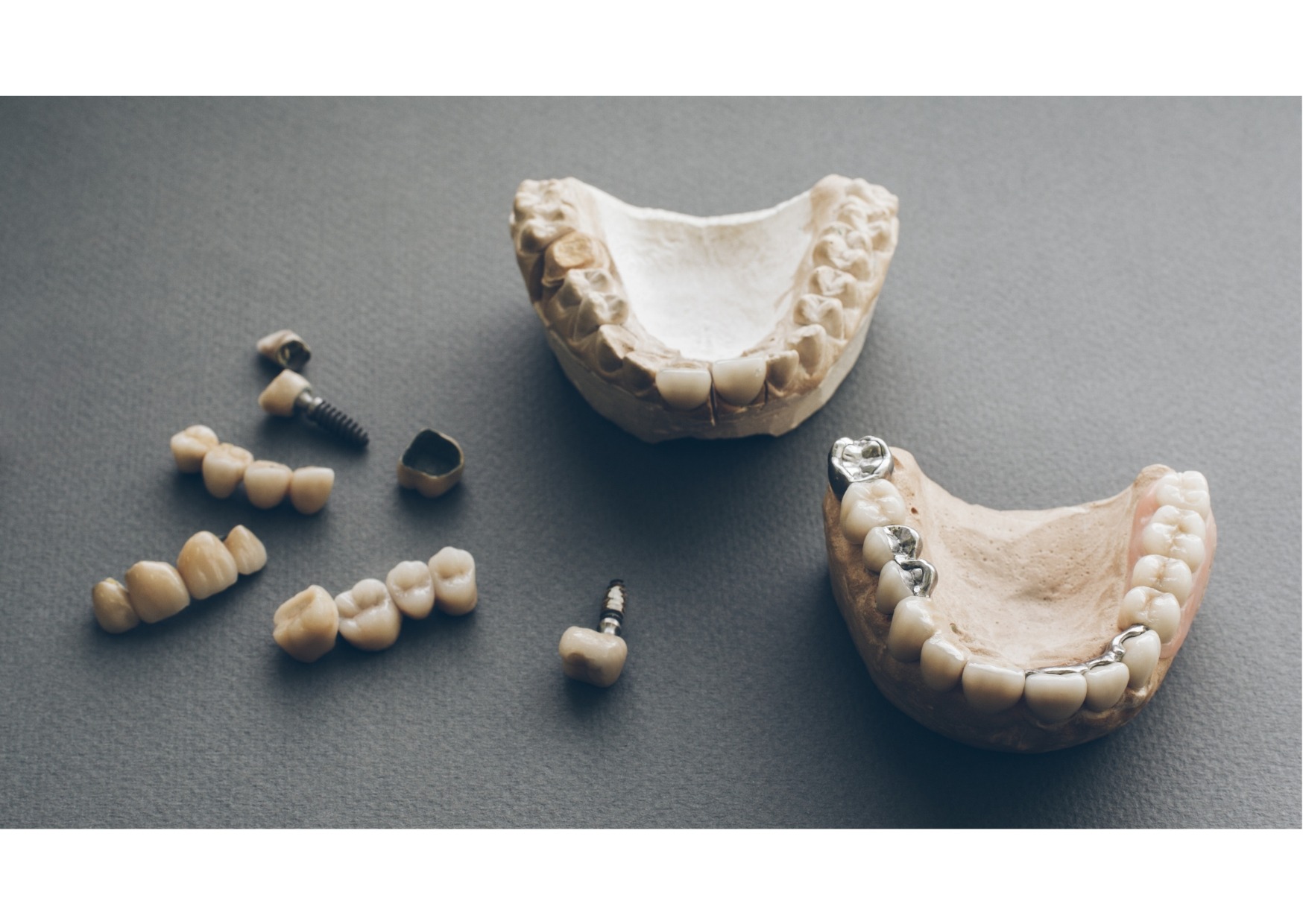 Dental implant models and replacement teeth used to explain dental implant costs and treatment options